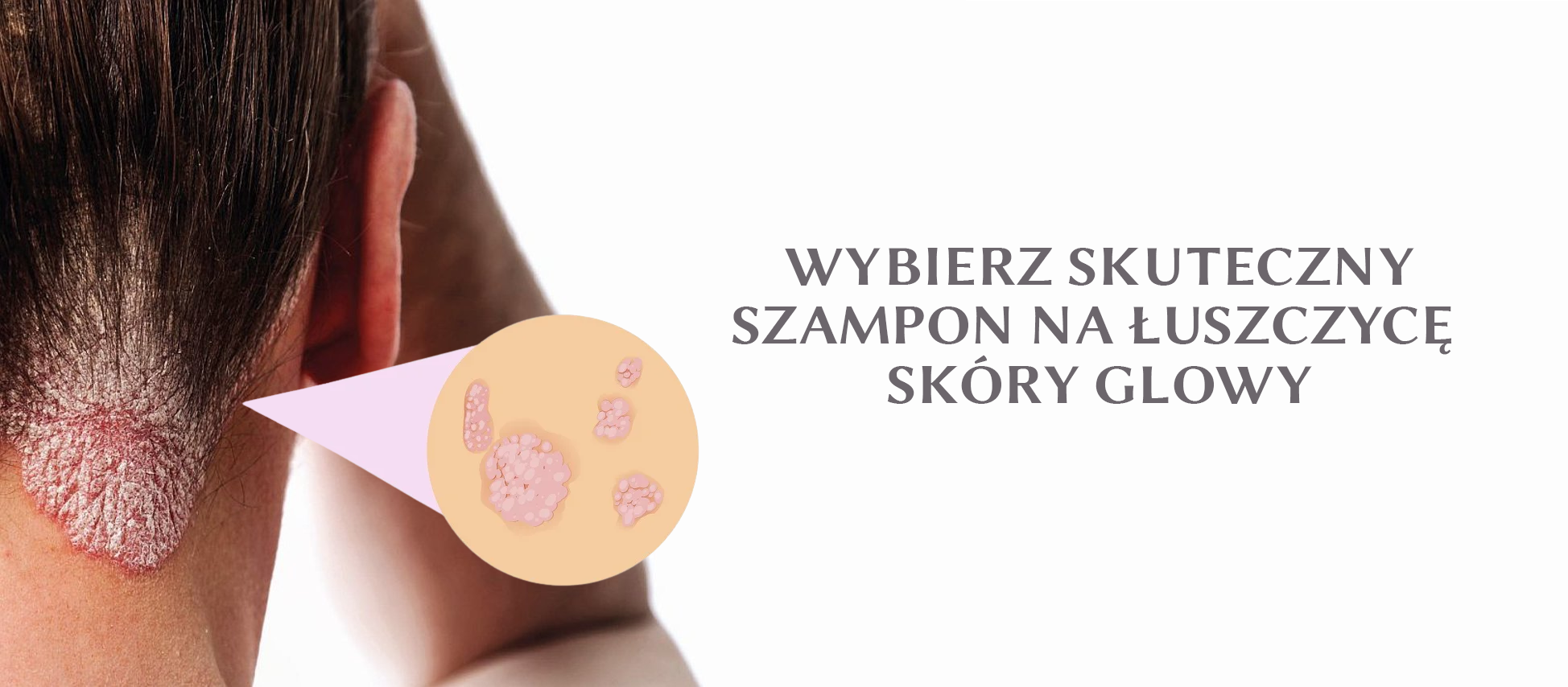 Szampon na łuszczycę z naturalnymi składnikami - Zdjęcie główne